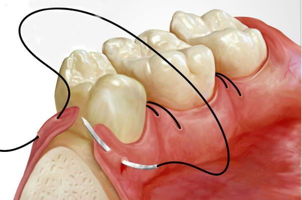 Характеристики стоматологических шовных материалов