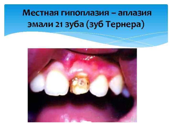Причины развития зубов Тернера