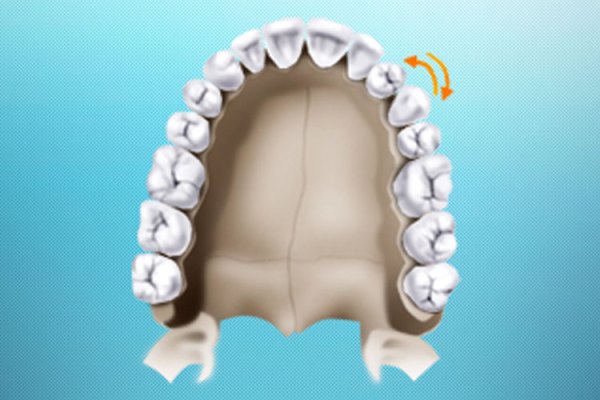 Причины формирования транспозиции зуба