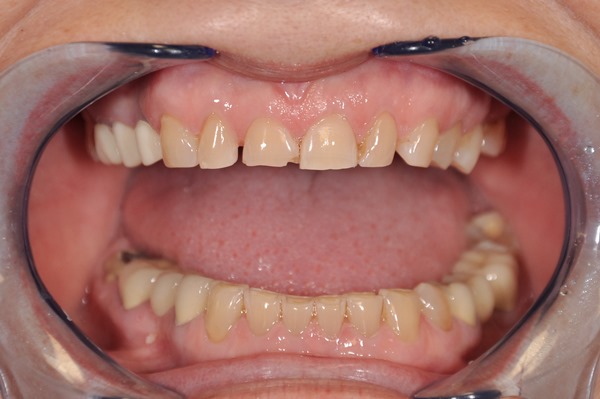 Требования к материалам при протезировании зубов с низкими коронками