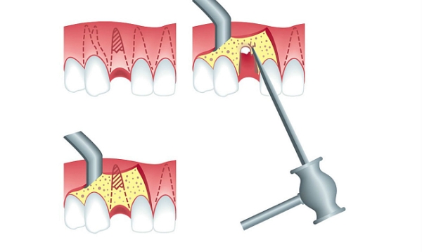 Показания к ампутации корня зуба