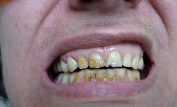 Последствия кислотного некроза зубов