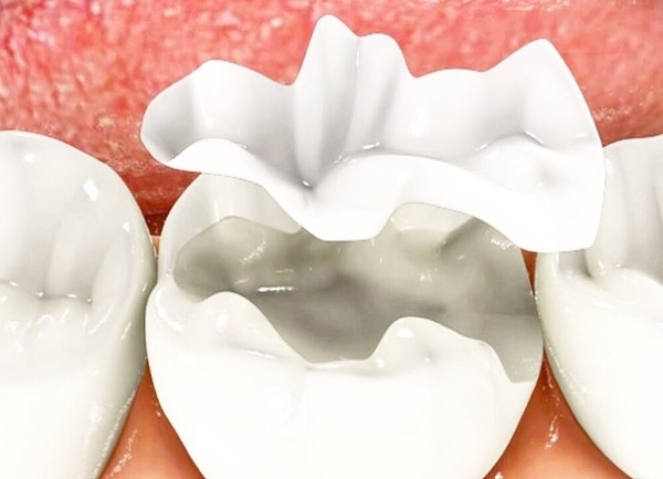 Причины разрушения жевательных зубов и техники реставрации