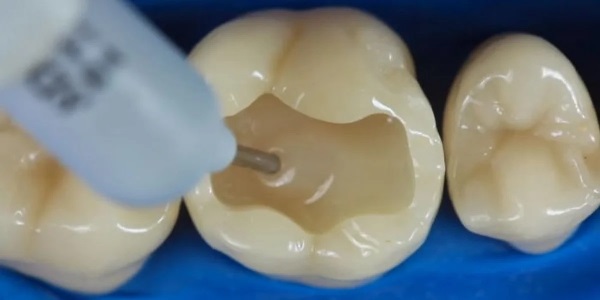 Характеристики жидкой пломбы для зубов