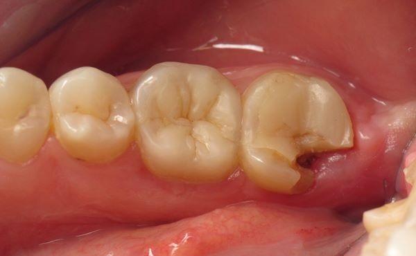 Показания к удалению стенки зуба