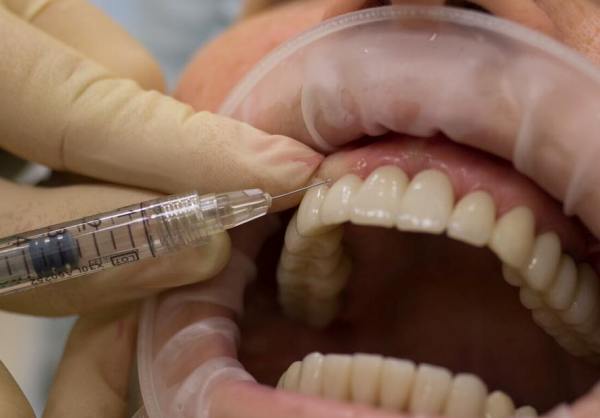 Как работает гиалуроновая кислота в стоматологии
