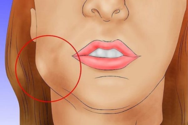 Этапы лечения опухоли челюсти