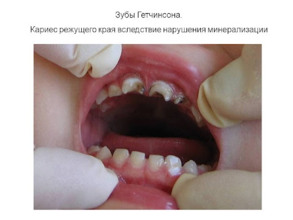 Этиология зубов Гетчинсона